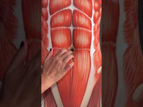 Do You Have Diastasis Recti?