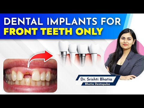 Dental Implants for FRONT TEETH only: Dr. Srishti Bhatia #implants #dentist #newteeth