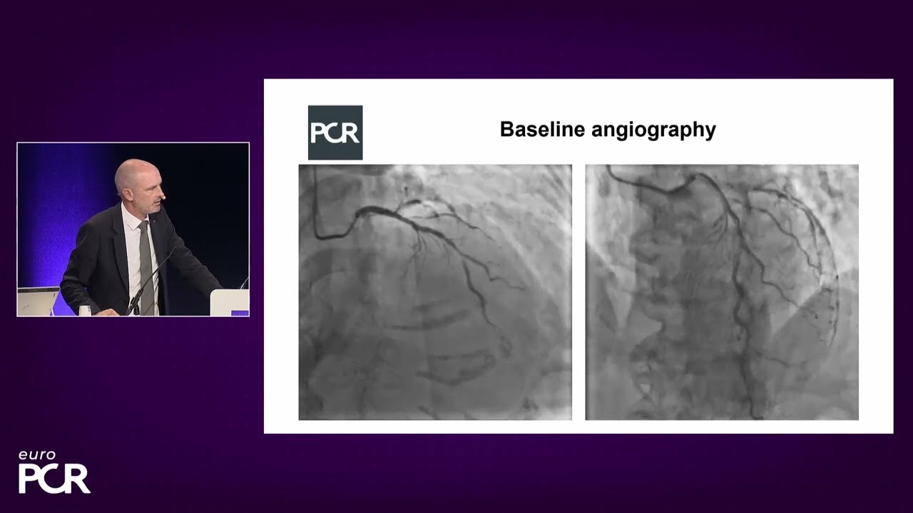 Complex PCI in high bleeding
