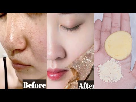 Dark spots on Face removal Cream | Viral gram/besan flour mask for dark spots removal in 7 days