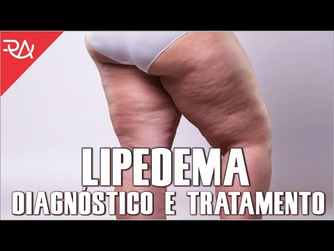 LIPEDEMA - Diagnóstico e tratamento - Rafael Aismoto