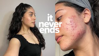 my acne is back, how I'm dealing with it & a weekend in toronto with the girls!