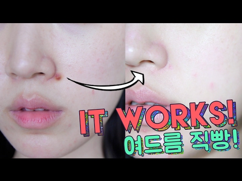 S.O.S Skincare Routine for Acne // How To Calm Down Acne FAST & IT WORKS! 🌴 Liah Yoo