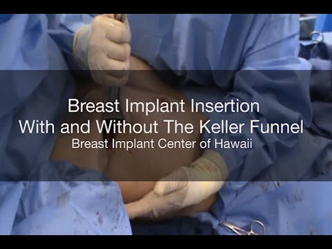 Breast Implant Insertion With and Without The Keller Funnel - Breast Implant Center of Hawaii