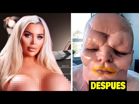 20 Cirugías Que Salieron Terriblemente Mal De Famosos 😨