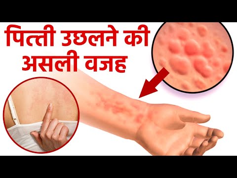 पित्ती उछलने का कारण | पित्ती उछलने का घरेलू उपाय | पित्ती उछलने पर क्या लगाएं | Boldsky