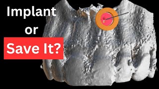 How We Use 3D Guides for Precision Apical Surgery