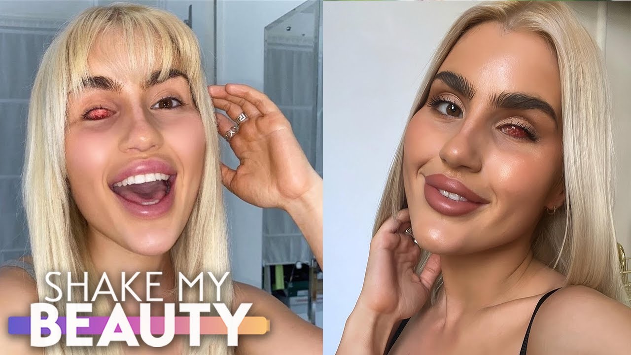 Cancer stole my eye - not my life - shake my beauty
