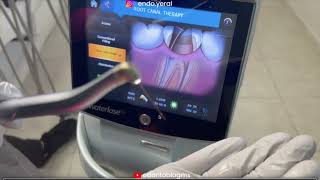 Preparación del conducto radicular 🦷 con láser 