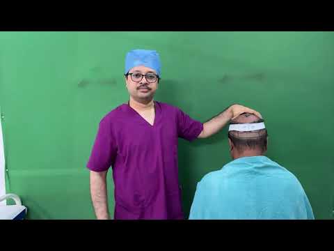 FUT হেয়ার ট্রান্সপ্লান্ট মার্কিং ও প্ল্যানিং l Bain Clinic Kolkata | Dr. Jayanta Bain