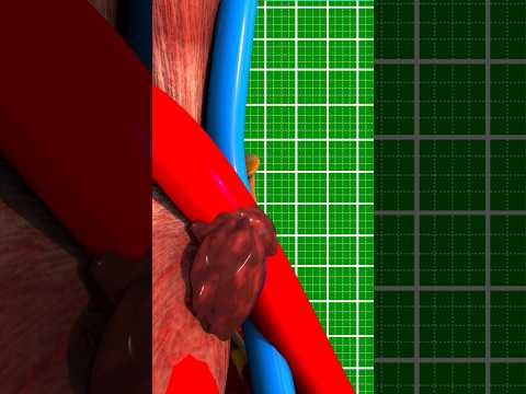 Blown Veins 😟 (explained) #shorts