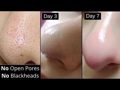 Skin चमकेगी| नाक, Cheeks से Clogged Pores, Blackheads, Whiteheads जड़ से खत्म करे सिर्फ 1 हफ्ते मे|