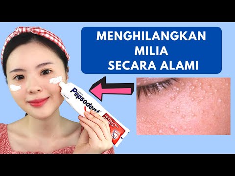 Cara Alami Menghilangkan Milia (AMPUH & CEPAT)