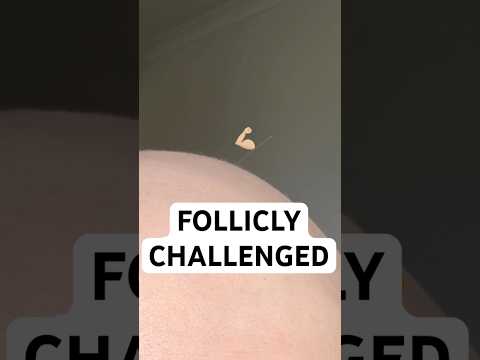 Follicly challenged? Or very focused on this one follicle? #alopecia #hairloss #funny #bald #hair