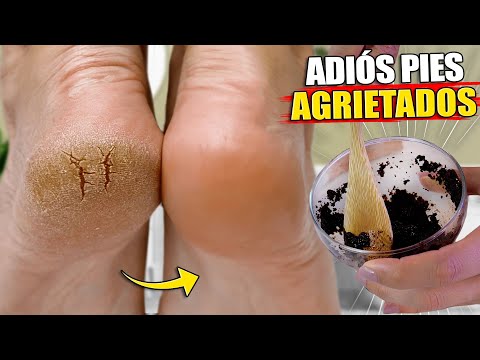 ¡Di Adiós a los PIES SECOS Y AGRIETADOS! Receta Casera Maaaravillosa!