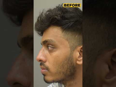 "From Patchy to Perfect: The Incredible Before & After of Beard Transplant"
