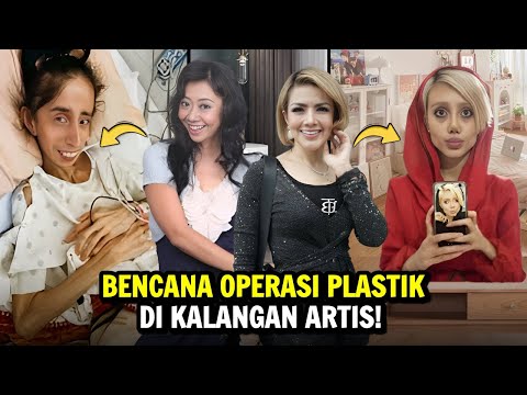 7 Artis Disebut Gagal Melakukan Operasi Plastik