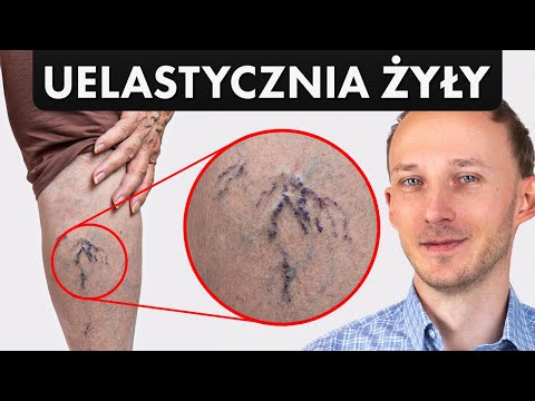 Zapomniany składnik diety, który cofa żylaki i pajączki (ważne)