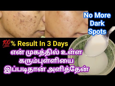 🔥🔥3 Days Acne Treatment At home - Remove Acne Scars & dark spot At home💯 / pimple treatment at home