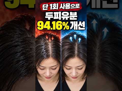매일 감아도 가렵다면? 탈모 부르는 지루성 두피염의 진실