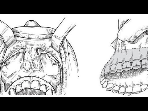 Juvenile Nasopharyngeal Angiofibroma (JNA) surgery at Aminu Kano Teaching Hospital AKTH