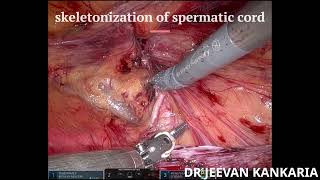 Robotic Inguinal Hernia TAPP