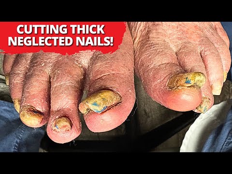Satisfying Thick Toenail Removal | Cutting Neglected Overgrown Nails