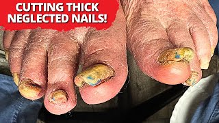 Satisfying Thick Toenail Removal | Cutting Neglected Overgrown Nails