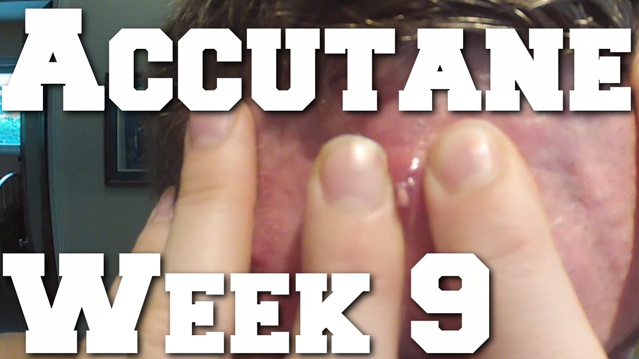 Lifting HEAVY, Side Effects & Cysts on Accutane (Week 9)