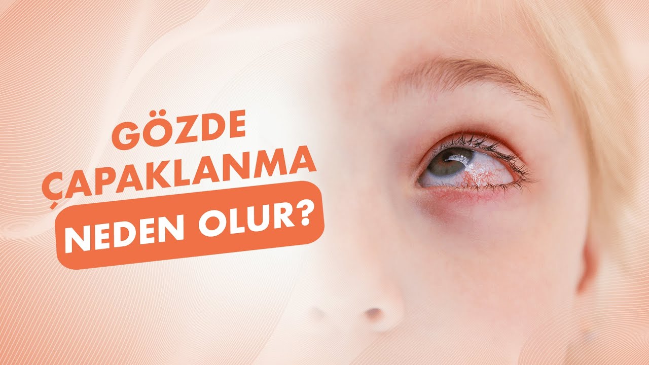 Gözde Çapaklanma Neden Olur?│Doç. Dr. Faruk Kaya