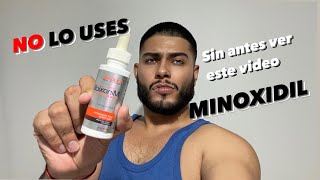 Probé Minoxidil por 2 Meses | BARBA Y CEJAS