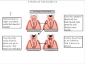 Stages and Effects of Tooth Decay