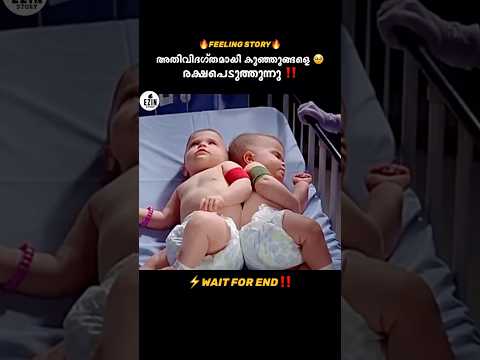 Conjoined twin babies || #shortsvideo #youtubeshorts #ytshortsindia #trending