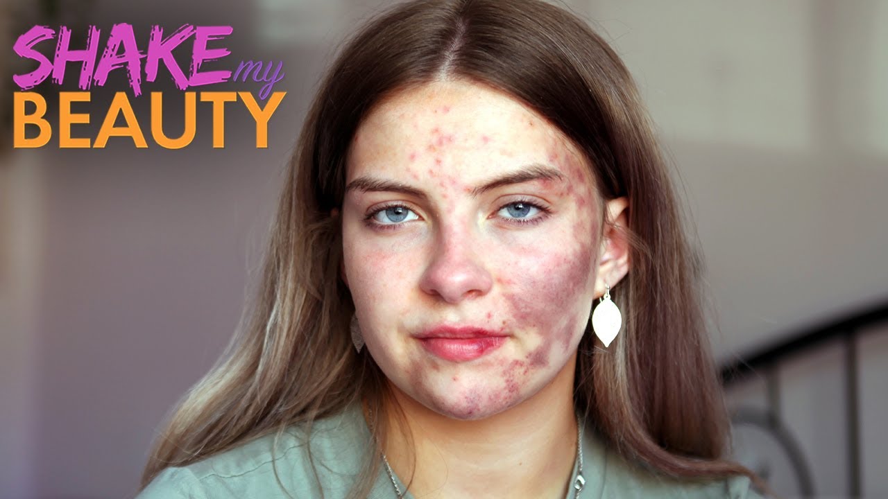 Doctors are baffled by my mystery skin condition - shake my beauty
