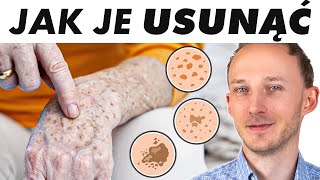 CIEMNE PLAMY: co się dzieje ze zdrowiem, gdy masz je na skórze