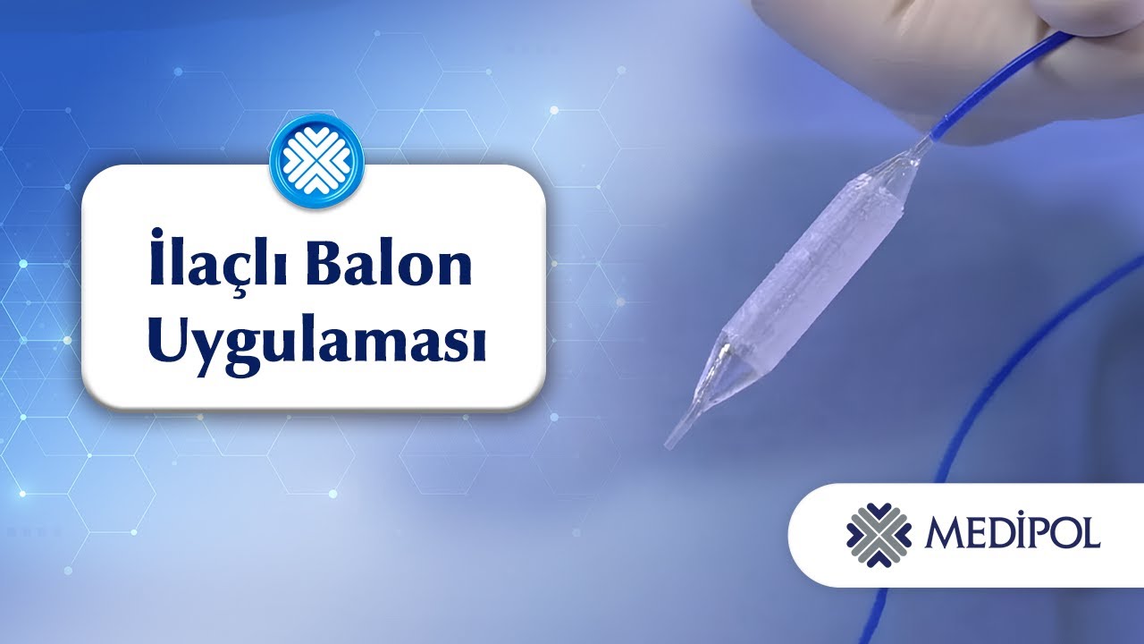 İdrar Kanalı Daralmasında İlaçlı Balon Uygulaması Nedir?