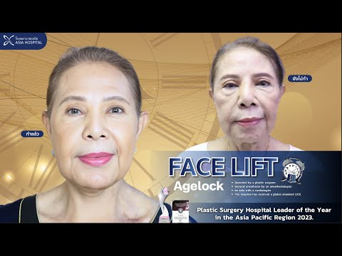 หลังดึงหน้าดึงคอถูกใจมากๆเพื่อนๆทักเยอะโรงพยาบาลเอเซียasiaho