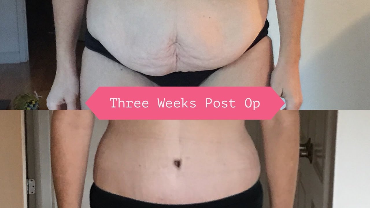 Post-surgery body progress photo, three weeks later.