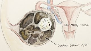 Echogenic Mural Nodule in an Ovarian Cyst | Dermoid Cyst or Hemorrhagic Cyst?