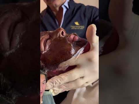 Plastic Surgeon Reacts to Phenol Peel- Would You Do This?