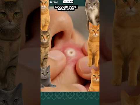 Clogged Pore Near to Nose ! It will Surprise You !! #shortsfeed #shorts