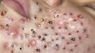 Loan Nguyen Acne Treatment 125c