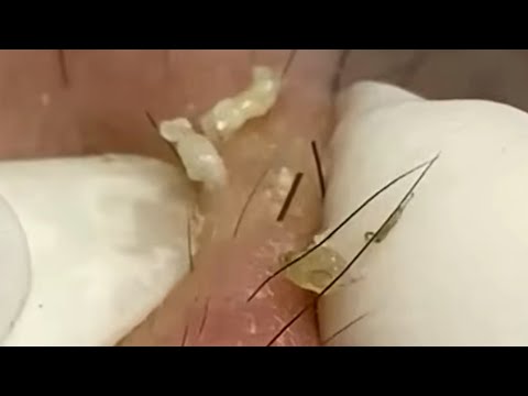 Blackheads & Whiteheads Satisfying Removal @0614