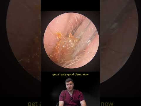 2CM Wax Plug Comes Out Whole 😳👂 - EP1291