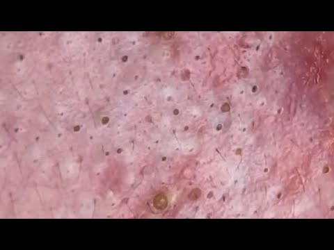 Blackheads & Whiteheads Satisfying Removal @0339