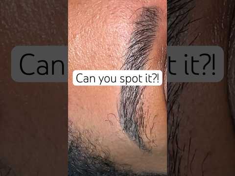 I Thought Every Eyebrow Hair Was Transplanted… I Was Wrong 👀