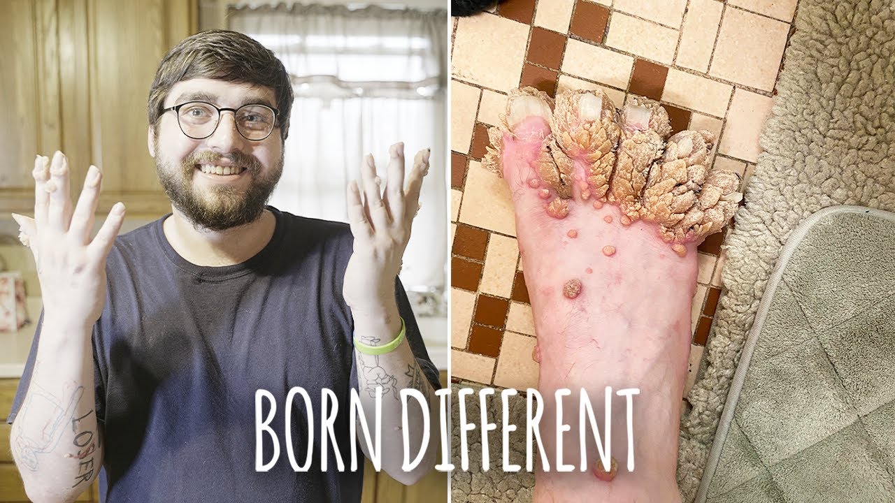 My hands and feet are covered in growths - born different