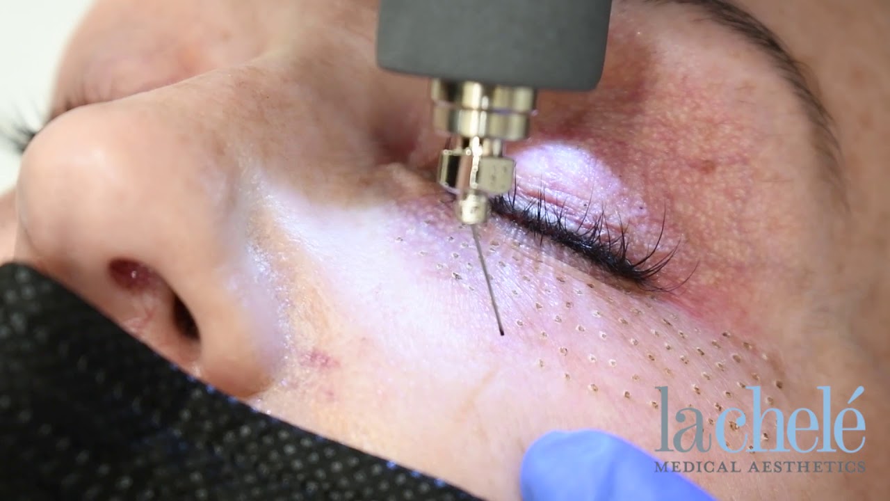 Microneedling treatment on facial skin close-up.