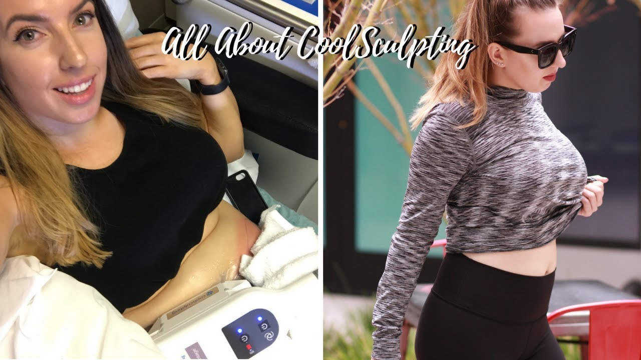 CoolSculpting before and after results image.