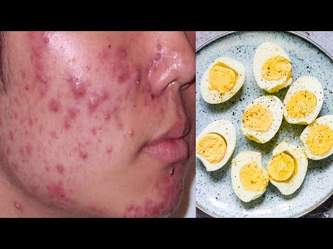 उबले अंडे खाने के बाद गलती से भी न खाएं ये चीजें